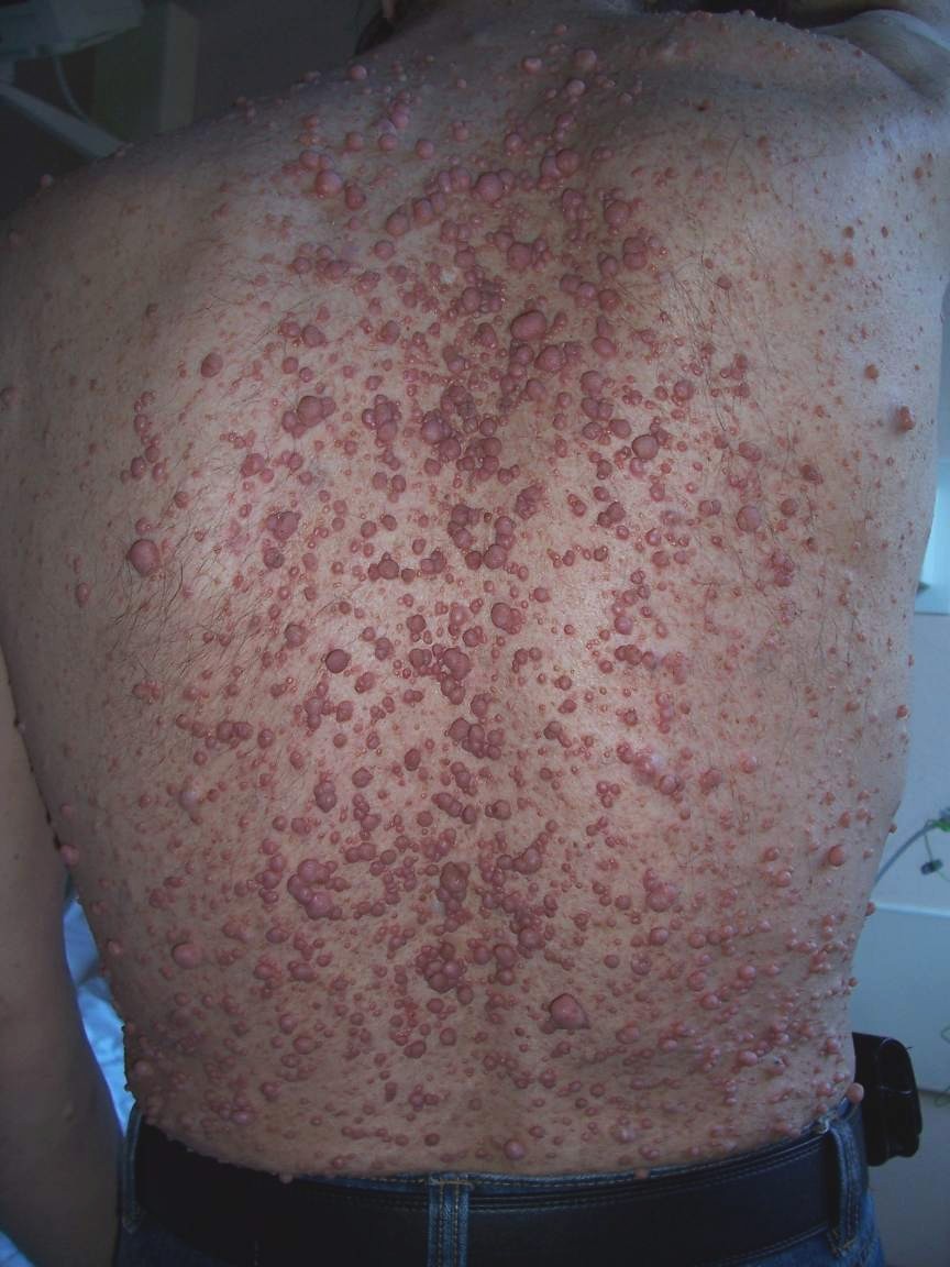 Espalda de una persona con neurofibromatosis